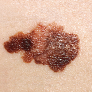 Photo of melanoma