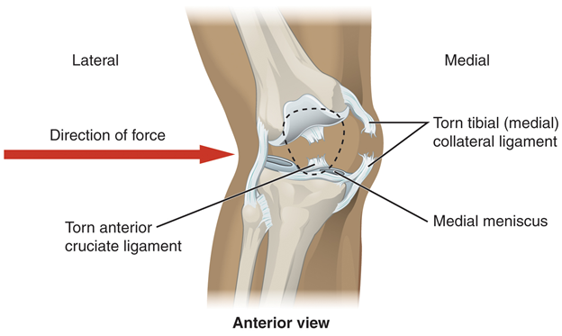 Diagram of knee injury