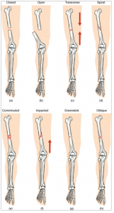 10.5 Fractures: Bone Repair – Fundamentals of Anatomy and Physiology