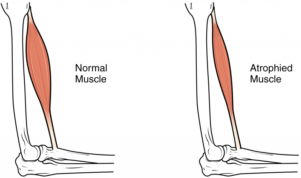 Diagram of normal muscle and atrophied muscle