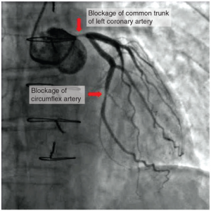 black and white image of Atherosclerotic coronary arteries
