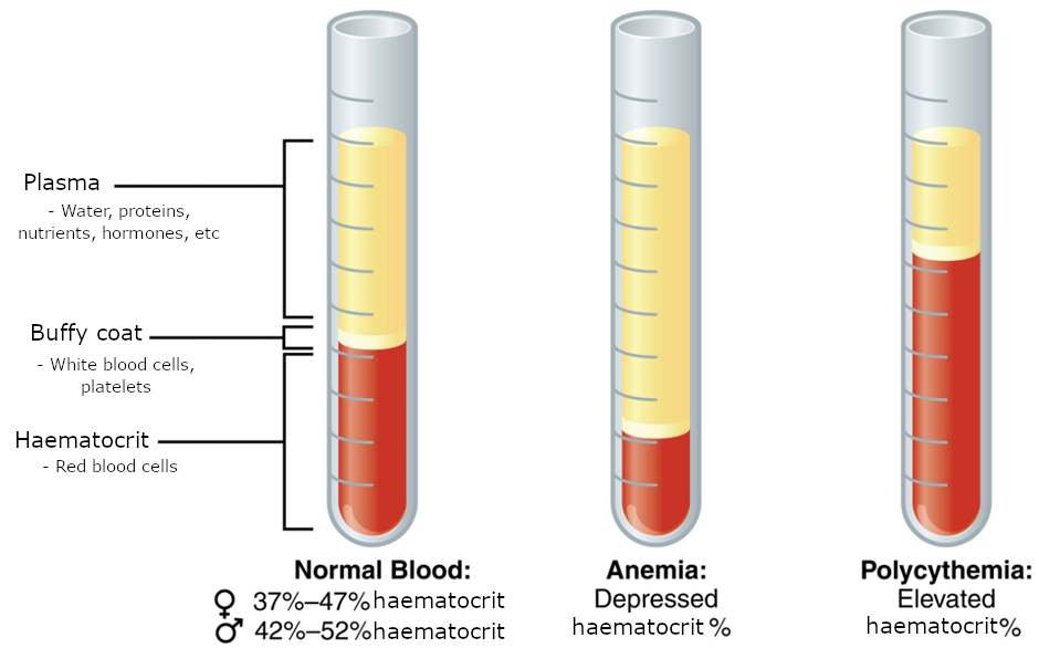 Three viles of blood. One reprsenting normla blood, one representing anemia and one polcyhemia