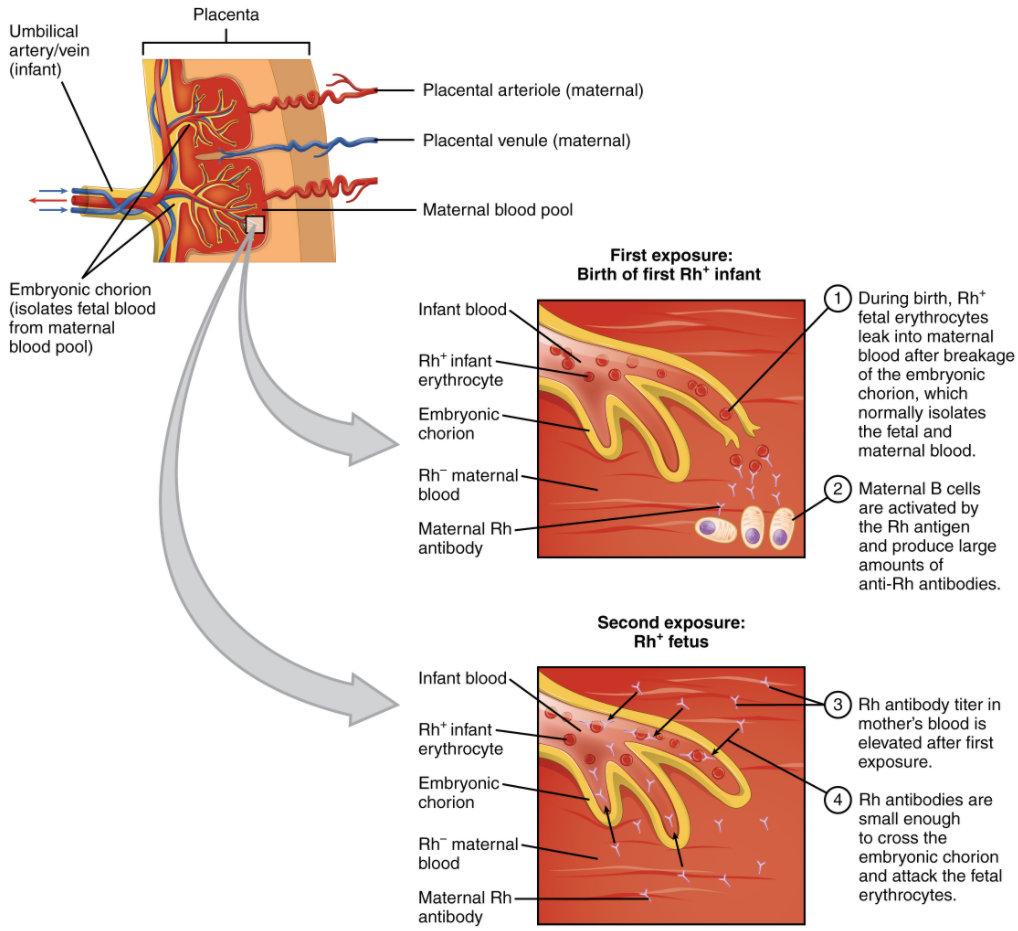 Diagram of Erythroblastosis fetalis