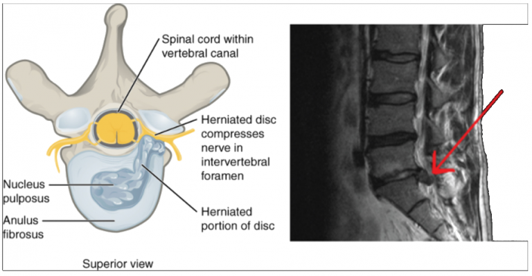 10.10 The Vertebral Column – Fundamentals of Anatomy and Physiology