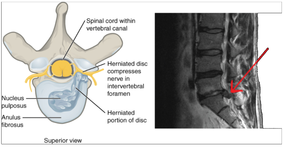 Diagram and x-ray of Herniated intervertebral disc.