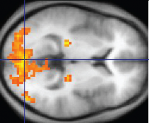 This fMRI shows activation of the visual cortex in response to visual stimuli.