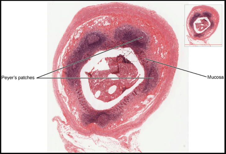 Mucosa-associated lymphoid tissue (MALT) nodule