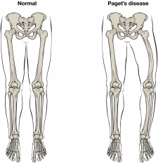 10.3 Bone Structure – Fundamentals of Anatomy and Physiology