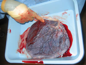 Photo of placenta