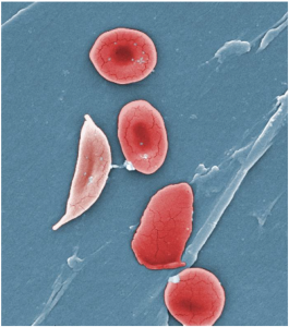 Image of sickle cells